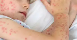 হামের টিকা নিয়ে সরকারের জরুরি যে নির্দেশনা দিল