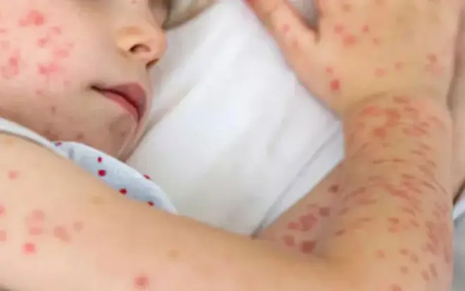 হামের টিকা নিয়ে সরকারের জরুরি যে নির্দেশনা দিল