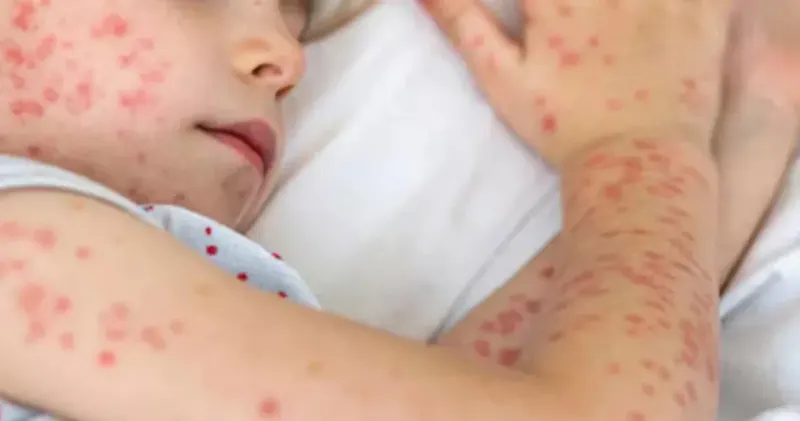 হামের টিকা নিয়ে সরকারের জরুরি যে নির্দেশনা দিল