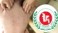 দেশজুড়ে ভয়াবহ আকার ধারণ করছে হাম বাড়ছে মৃত্যু-আক্রান্ত