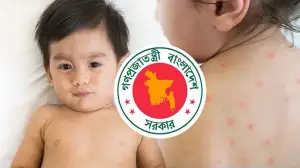 হাম নিয়ে উদ্বেগ বাড়ছেই, ২৪ ঘণ্টায় প্রাণ গেল আরও ১১ শিশুর