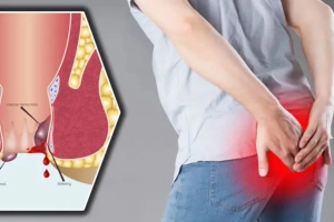 পাইলস বা অর্শ্ব কেন হয়? কারণ, লক্ষণ ও প্রতিকারের পূর্ণাঙ্গ গাইড
